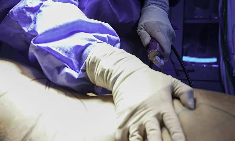 Liposuction, Türkçede yağ aldırma ameliyatı olarak bilinen, vücudun belirli bölgelerinde biriken fazla yağların cerrahi yöntemle alınmasını sağlayan estetik bir işlemdir.