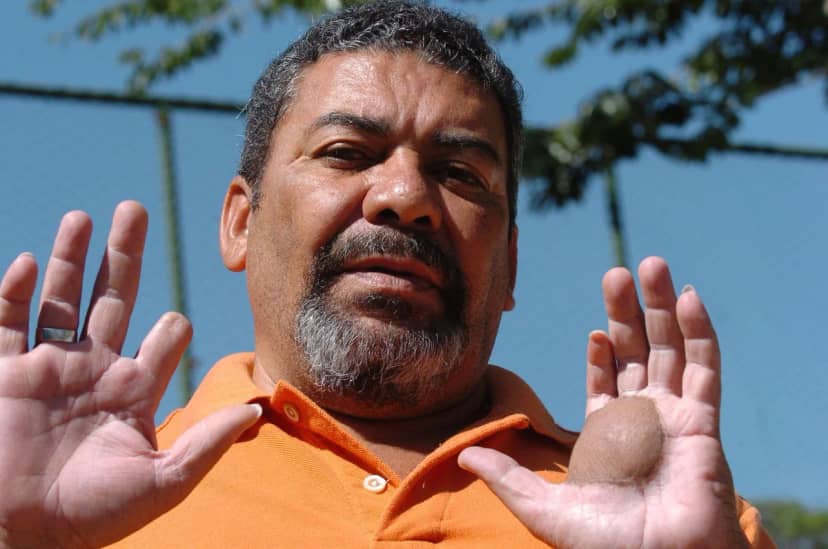 Goiania'da sezyum-137 kazası mağduru Odesson, yaklaşık 40 yıl sonra anılarını yazıyor