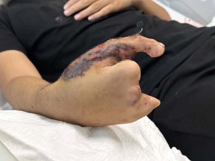 Ayak parmağı eline nakledildi! 5 parmağı kopan 13 yaşındaki çocuğa nadir ameliyat: 4 ay sonra kullanabilecek