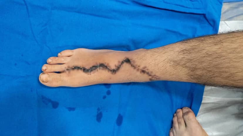 Ayak parmağı eline nakledildi! 5 parmağı kopan 13 yaşındaki çocuğa nadir ameliyat: 4 ay sonra kullanabilecek