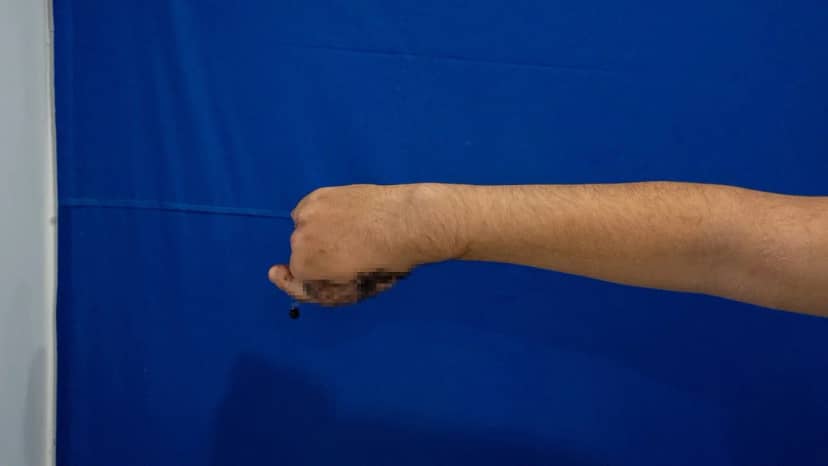 Ayak parmağı eline nakledildi! 5 parmağı kopan 13 yaşındaki çocuğa nadir ameliyat: 4 ay sonra kullanabilecek